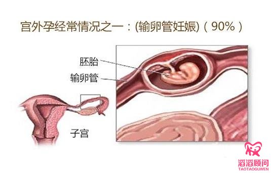 宫外孕需要怎么治疗?