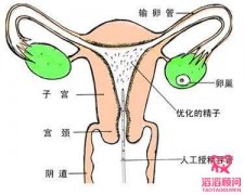 什么是人工授精？什么情况下需要人工授精治疗？