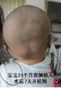解放军总医院关于人工耳蜗双侧植入的问与答
