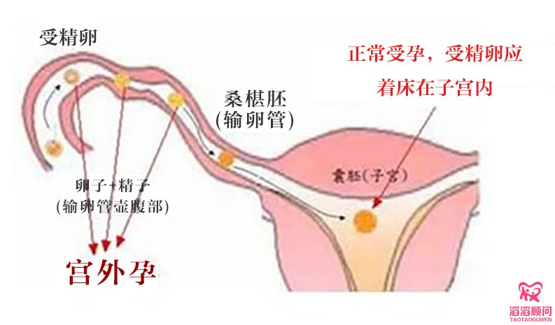 β-hCG值判断是否宫外孕