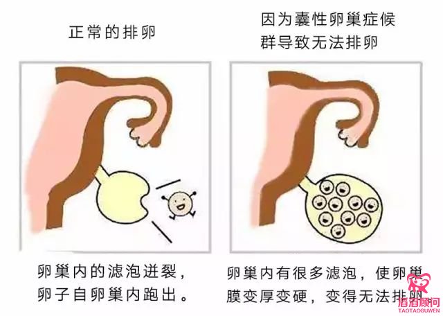 多囊卵巢综合征