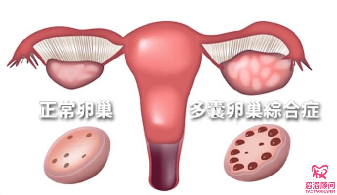 多囊卵巢综合征