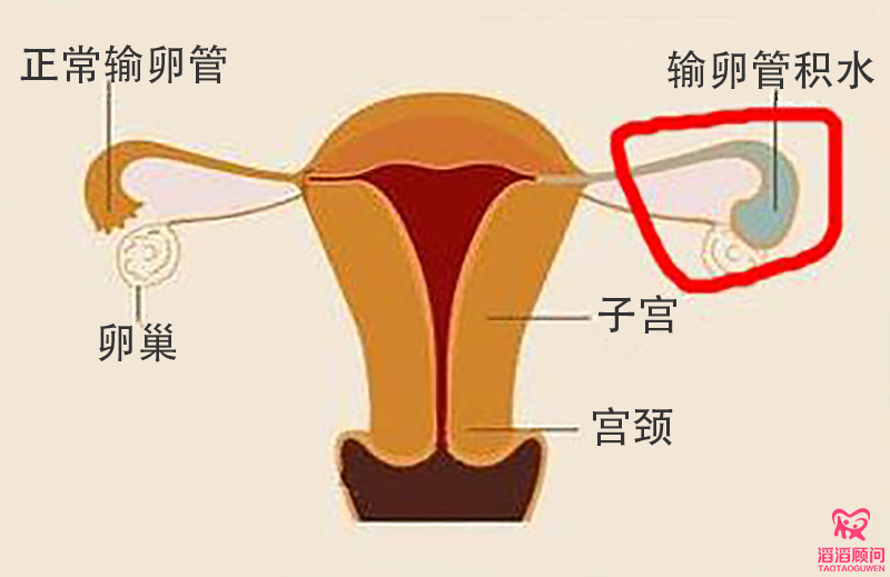 输卵管积水