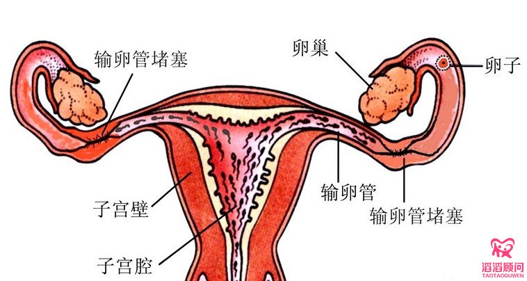 输卵管堵塞