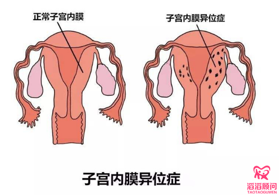 俄罗斯试管婴儿