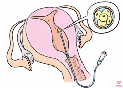 试管婴儿优质胚胎不能着床的原因